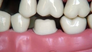 Full metal crown preparation  for dental students [upl. by Kilroy73]