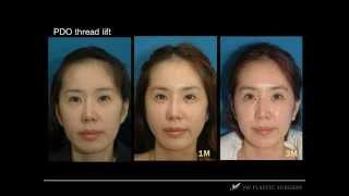 Korean Thread Lift amp Nose Filler Before amp After Surgery Pictures From JW Plastic Surgery [upl. by Noreht]