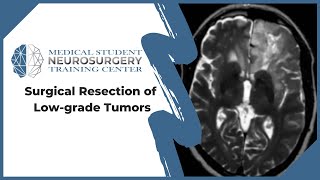 Surgical Resection of Lowgrade Tumors [upl. by Renba170]