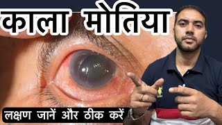 काला मोतिया । सबलबाई । Glaucoma [upl. by Jarrod]