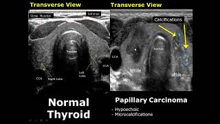 Thyroid Ultrasound Normal Vs Abnormal Image Appearances Comparison  Thyroid Pathologies USG [upl. by Cesar]