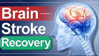 Brain Stroke Recovery  Paralysis Causes amp Treatment  Dr Puru Dhawan [upl. by Assilak]