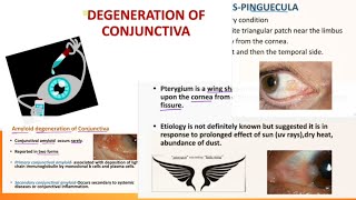 conjunctival degeneration  pinguecula  pterygium concretion ophthalmology  symptoms amp treatment [upl. by Hanimay]