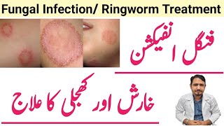 Fungal Infection Complete Treatment Ringworm In Urdu Hindi  Irfan Azeem [upl. by Naples]