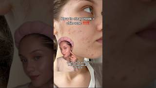 CHEEK amp CHIN ACNE‼️ acne hyperpigmentation darkspots skincaretips tretinoin hormonalacne [upl. by Ardnaek575]