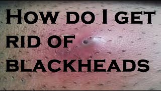 How do I treat blackheads permanently [upl. by Rora]