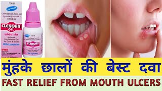 clenora gel uses in hindi clenora gel for apthous ulcerscold soresfever blisters [upl. by Izmar]