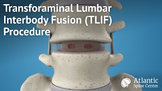 Transforaminal Lumbar Interbody Fusion TLIF Procedure [upl. by Yerak]