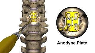 CoreLink Surgical Anodyne Plate System [upl. by Eivi]