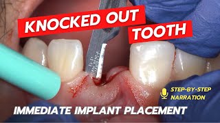 Immediate Implant post avulsion [upl. by Lansing]