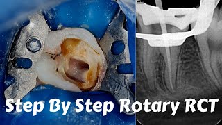 Live Steps Root Canal Rotary Protaper Endodontic Procedure ACP BMP obturation irrigation [upl. by Cazzie]