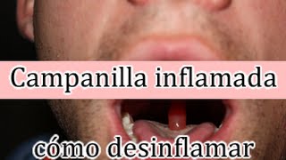 Campanilla inflamada tratamiento para desinflamar [upl. by Ahsanat]