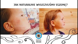 Jak naturalnie wyleczyliśmy egzemę naszej córki ULLENKAS METHOD [upl. by Allerie652]