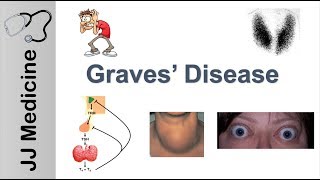 Graves Disease and Graves Ophthalmopathy  Signs Symptoms Diagnosis and Treatment [upl. by Sucram]