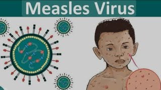 TOPICquot31MEASLES DISEASEamp ITS  DIAGNOSIS SYMPTOMS SIGNS PREVENTION COMPLICATIONS TREATMENT [upl. by Ahseenal806]