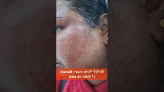 Steroid cream आपके चेहरे को ख़राब कर सकती है  steroidssideeffects betnovate betnovatencream [upl. by Gnehs]