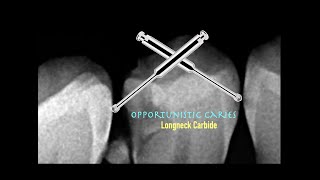 Opportunistic Caries  Minimally Invasive Approach [upl. by Leksehc]