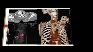 Hepatic artery pseudoaneurysim [upl. by Nosrac588]