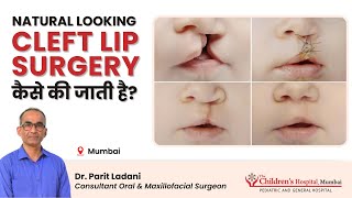 Cleft Lip and Palate Surgery which looks Natural by Dr Parit Ladani [upl. by Eniad]