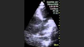 VSCAN Pulmonary regurgitation pocket ultrasound Insuficiencia pulmonar [upl. by Inattirb]