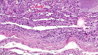 Leydig Cell Tumor  Ovary Histopathology [upl. by Young]