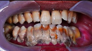 ScalingTeeth Cleaning  Should you get it done [upl. by Friedly41]