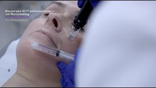 Revitaliza el rostro con Mesoterapia Microneedling [upl. by Torrence]