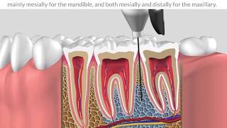 Protocole intraosseous anesthesia [upl. by Sille]