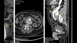 Type 1a endoleak [upl. by Nosreip]