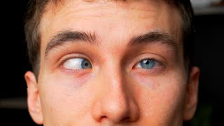 CROSS EYED What is Strabismus  Types Causes Treatments Eye Doctor Explains [upl. by Aivyls597]