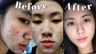 NIGHT SKINCARE ROUTINE UNTUK KULIT BERJERAWAT OILY amp ACNE PRONE SKIN [upl. by Ardnaeed742]