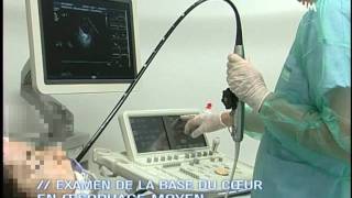 Echographie TransOesophagienne ETO  Film de formation [upl. by Pieter]