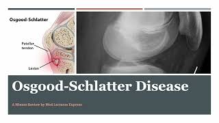 Osgood Schlatter Disease  A Minute Review [upl. by Atnoved308]