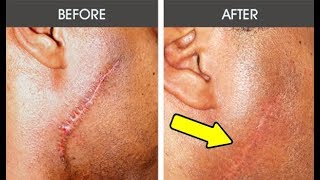 10 Hacks to Cure All Types of Scars amp Help Them Heal  Natural Home Remedies  Surgery Scar Removal [upl. by Mundy]