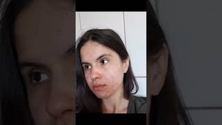 Minha experiência de 6 meses usando peroxido de benzoila para tratar a acne reels acne espinha [upl. by Ahsirhcal]