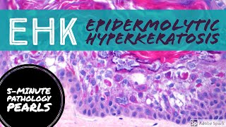 Epidermolytic Hyperkeratosis EHK 5Minute Pathology Pearls [upl. by Lashonde458]