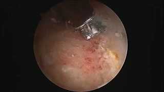 Hip Labral Tear debridement and Repair [upl. by Nade317]