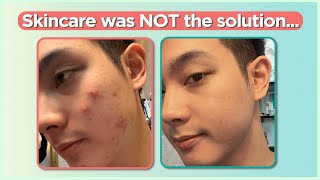 Confused sa pag treat ng ACNE Start here Beginners Guide  Jan Angelo [upl. by Llehsyt884]