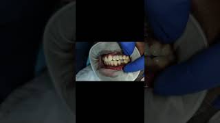 Cad cam milled GCam dental implant bridge for basal dental implants shorts [upl. by Wandy]