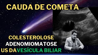 Colesterolose e Adenomiomatose da Vesícula Biliar [upl. by Tami]