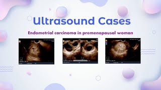 Endometrial carcinoma in premenopausal woman  Ultrasound cases [upl. by Aihsined178]