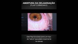 Como é feita a Cirurgia Refrativa a Laser para a correção da Miopia Hipermetropia e Astigmatismo [upl. by Lundin325]