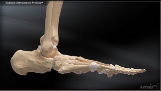 Subtalar Arthroereisis ProStop® [upl. by Ariajay]