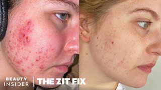 My 8Month Accutane Journey Side Effects And Results  The Zit Fix [upl. by Anikat107]