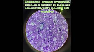 Cytologygalactocelebenign breast disease pathologymedical [upl. by Radmilla623]