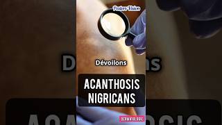 Acanthosis nigricans Acanthosis nigricans acanthosisnigricans hyperpigmentation pigmentation yt [upl. by Llireva]