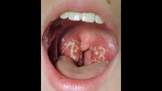 2 simple and fast home remedies for tonsils that works fast [upl. by Orv231]