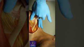 Coracoid Process  Shoulder injection Technique  shorts education [upl. by Ioj]