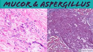 Mucormycosis amp Aspergillosis Angioinvasive Fungal Infection [upl. by Alegnaed]