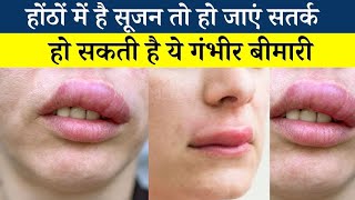 Angioedema cause and treatment होठों और आंखों की सूजन का इलाज [upl. by Tiphany]